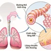 Ghép tế bào gốc tự thân để điều trị bệnh phổi tắc nghẽn mạn tính