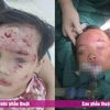 Phú Thọ: Bé gái 3 tuổi bị thương nặng do chó nhà hàng xóm cắn