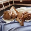 Trẻ em bị suy dinh dưỡng điều trị tại bệnh viện ở tỉnh Hajjah, Yemen. (Ảnh: THX/TTXVN)
