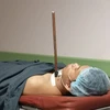 Bệnh nhân D. nằm trong phòng phẫu thuật với mũi chĩa còn đâm vào vùng cổ. (Nguồn: thanhnien.vn)