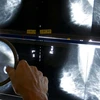 Bác sỹ X-quang sử dụng kính lúp để kiểm tra nhũ ảnh để phát hiện ung thư vú. (Nguồn: AP)