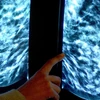 Phụ nữ cao tuổi chụp X-quang tuyến vú dễ bị chẩn đoán quá mức