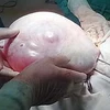 Phẫu thuật thành công khối u nang buồng trứng 4kg