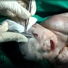 Mảnh đạn trên đầu em bé đã được gắp ra. (Nguồn: dailymail.co.uk)