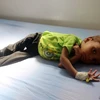 Điều trị cho một em nhỏ suy dinh dưỡng tại bệnh viện ở Sanaa, Yemen. (Nguồn: AFP/TTXVN)