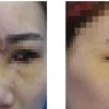 Một bệnh nhân bị tai biến do tiêm filler. Ảnh minh họa. (Nguồn: Vietnam+)