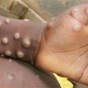 Các phần bị tổn thương xuất hiện trên tay và chân em nhỏ bị nghi mắc bệnh đậu mùa khỉ. (Ảnh: Getty Images/TTXVN) 