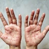 Các ban đỏ nổi trên tay một bệnh nhân mắc đậu mùa khỉ. (Ảnh: Shutterstock/TTXVN) 