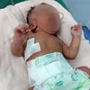 Sức khỏe bé gái sơ sinh 3 ngày tuổi (trú huyện Đăk Hà, tỉnh Kon Tum) bị teo thực quản bẩm sinh đã ổn định. (Ảnh: TTXVN phát)