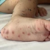 Nốt hồng ban ở chân của một trẻ mắc bệnh tay chân miệng. (Ảnh: Đinh Hằng/TTXVN) 