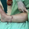 Sau 5 tiếng phẫu thuật, các bác sỹ Bệnh viện Đa khoa vùng Tây Nguyên đã nối liền thành công bàn chân bị đứt rời của bệnh nhân. (Ảnh: Bệnh viện Cung cấp)