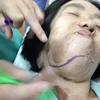 Bệnh nhân với khối u lớn gây lệch mặt. (Ảnh: PV/Vietnam+)