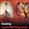 Nepal: Hình ảnh cảnh báo sức khỏe chiếm 90% diện tích vỏ bao thuốc lá