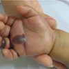 Cứu sống em bé 2 tuổi người H’Mông bị rắn độc cắn rất nặng