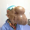 Bà Triệu Mùi Chài với khối u khổng lồ trên mặt. (Ảnh:T.G/Vietnam+)