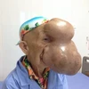 Triệu Mùi Chài với khối u khổng lồ trên mặt. (Ảnh:T.G/Vietnam+)