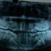 Phim chụp hình ảnh những răng thừa của bệnh nhân ở cả hai hàm. (Ảnh: PV/Vietnam+)