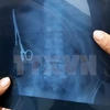 Hình ảnh chụp X-quang chiếc kéo trong ổ bụng của ông Nhật. (Ảnh: Bùi Đức Hiếu/TTXVN)