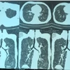 Hình ảnh chụp CT ngực của bệnh nhân cho thấy có tình trạng hẹp khí quản ở đoạn 1/3 trên. (Ảnh: BV cung cấp)