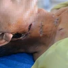 Bệnh nhân với những tổn thương ở vùng cổ, ngực. (Ảnh: PV/Vietnam+)