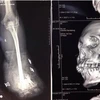 Hình ảnh chụp X-quang về tai nạn thương tích của một bệnh nhân bị tai nạn do pháo nổ tại Bệnh viện Trung ương Quân đội 108. (Ảnh: PV/Vietnam+)