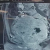 Hình ảnh chụp khối u của bệnh nhân. (Ảnh: PV/Vietnam+)