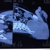 Phim chụp khối u của bệnh nhân. (Ảnh: PV/Vietnam+)