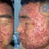 Bệnh nhân nhập viện với tình trạng nhiều mụn mủ, mụn bọc đầy mặt. (Ảnh: PV/Vietnam+)