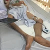 Một bệnh nhân mắc bệnh Whitmore đã được điều trị thành công tại Bệnh viện Bạch Mai. (Ảnh: PV/Vietnam+)