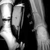 Chân của bệnh nhân sau khi bị lưỡi cưa cắt qua. (Ảnh: PV/Vietnam+)