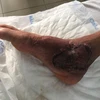 Chân của bệnh nhân sau khi được điều trị. (Ảnh: PV/Vietnam+)