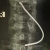 Hình ảnh chiếc thanh sắt cắm vào cổ bệnh nhân. (Ảnh: PV/Vietnam+)
