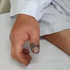 Một trường hợp bệnh nhân bị rắn cắn. (Ảnh: PV/Vietnam+)