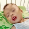 Bệnh nhân nhập viện với tổn thương vùng miệng và hạ họng thanh môn phù nề xung huyết. (Ảnh: PV/Vietnam+)