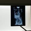 Hình ảnh trên phim chụp cho thấy cột sống của bệnh nhân uốn như chữ S. (Ảnh: PV/Vietnam+)