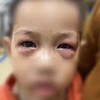 Bệnh nhi đau mắt đỏ. (Ảnh: PV/Vietnam+)