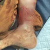 Cẳng chân của bệnh nhân bị chó cắn. (Ảnh: BVCC)