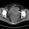 Hình ảnh chụp cắt lớp vi tính. Dụng cụ tử cung xuyên qua thành tử cung vào ruột (mũi tên trắng). (Ảnh: BVCC)