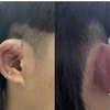 Tình trạng vành tai phải của bệnh nhân bị phù nề, nhiễm khuẩn khi nhập viện. (Ảnh: PV/Vietnam+)