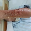 Phần cánh tay của bệnh nhân bị nhiễm trùng. (Ảnh: BVCC)