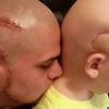 Ông bố xăm hình vết sẹo giống vết mổ phẫu thuật não của con trai. (Nguồn: BBC)