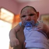 Một trẻ sơ sinh bị mắc căn bệnh đầu nhỏ do mẹ bị nhiễm virus Zika khi mang thai. (Nguồn: THX/TTXVN)