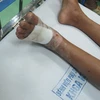 Bệnh viện Phụ sản-Nhi Đà Nẵng cứu sống bệnh nhi bị rắn cực độc cắn