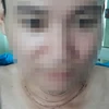 Bệnh nhân Huỳnh Thanh Hùng được phẫu thuật ung thư tuyến giáp. (Ảnh: Đinh Văn Nhiều/TTXVN)