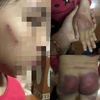 Làm rõ vụ một bé gái ở Thanh Hóa nghi bị bố đẻ bạo hành