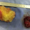 Hai khối u kích thước lớn di động trong tim của bệnh nhân. (Ảnh: Lê Xuân/TTXVN)
