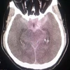 Hình ảnh CT sọ của bệnh nhân trước can thiệp. (Ảnh: TTXVN phát)