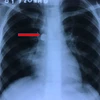 Hình ảnh X-quang cho thấy dị vật nằm trong phổi. Ảnh minh họa. (Nguồn: bvndtp.org.vn)