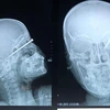 Hình ảnh cận lâm sàn của bệnh nhân A.T bị dị vật đâm xuyên nhãn cầu vào nền sọ. (Ảnh: TTXVN phát)