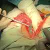 Bác sỹ Bệnh viện Đa khoa tỉnh Bạc Liêu phẫu thuật lấy lưỡi dao trong bụng bệnh nhân Lưu Kỳ Sang. (Ảnh: Tuấn Kiệt/TTXVN)